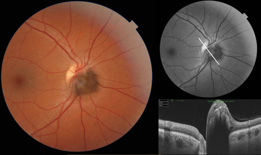 Figure 2. Mélanocytome. A gauche : Rétinophotographie couleur montrant la lésion papillaire pigmentée. A droite en haut : Cliché en autofluorescence. A droite en bas : Coupe OCT passant par la lésion (photo : Dr Frau, CHNO des Quinze-Vingts).