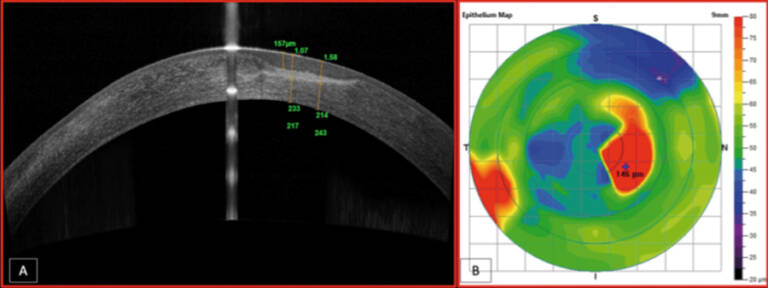Figure 7. Suivi sur 1 an en mapping épithélial d’un patient porteur d’un kératocône bilatéral avec réduction de la surface d’amincissement de l’épithélium cornéen sur les 2 yeux après l’arrêt des frottements oculaires et l’adaptation en lentille sclérale.