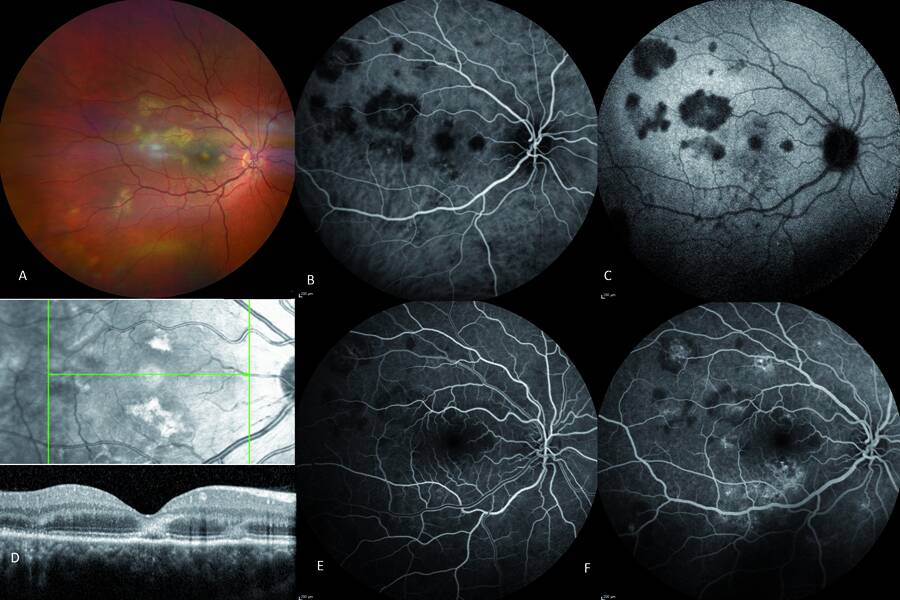 Figure 2. Épithéliopathie en plaques avec atteinte fovéolaire de l’œil droit : les lésions jaunes sont visibles en rétinophotographie (A) et typiques en OCT (D) : interruption de la zone ellipsoïde et de la membrane limitante externe, hyperréflectivité de la couche nucléaire externe. La non-perfusion de la choriocapillaire est visible hypofluorescente dès les phases précoces de l’angiographie à l’ICG (B) et à la fluorescéine (E), et persiste au temps tardif de l’ICG (C). Remplissage progressif rétinien au temps tardif en fluorescéine (F).