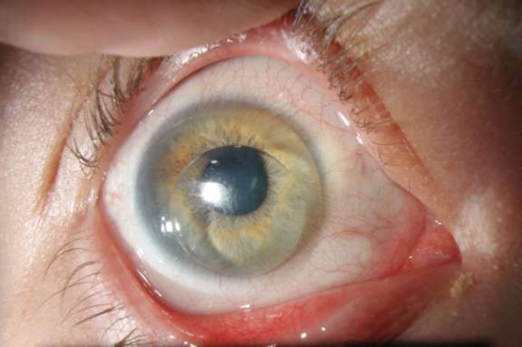 Figure 2. Lentille rigide de petit diamètre sur greffe de cornée : la vision est fluctuante.