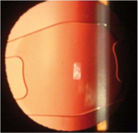 Figure 3. Implant phake.
