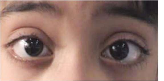 Figure 1. Enfant myope fort (-15 D), équipé en lentilles.