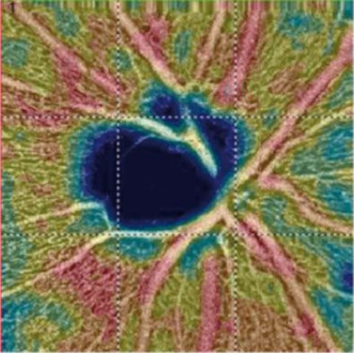 Détail du relevé OCT angiographie de la TNO avec visualisation du réseau capillaire péripapillaire et évaluation de la densité vasculaire en OCT-SD Avanti TRVue