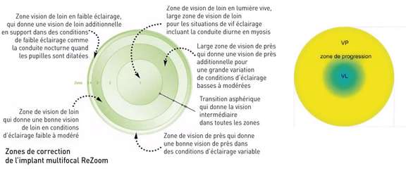 Figure 3. Design optique d’un implant multifocal, à rapprocher d’une lentille progressive à vision de loin centrale ; image allaboutvision.com