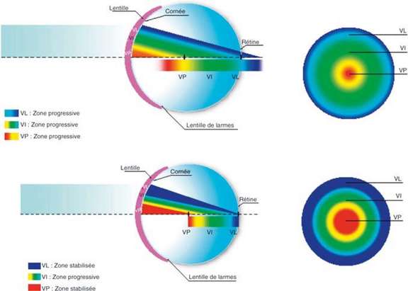 Figure 1. Design d’une lentille multifocale à vision de près centrale ; images Dr Peyre, rapport SFO Presbytie 2012.
