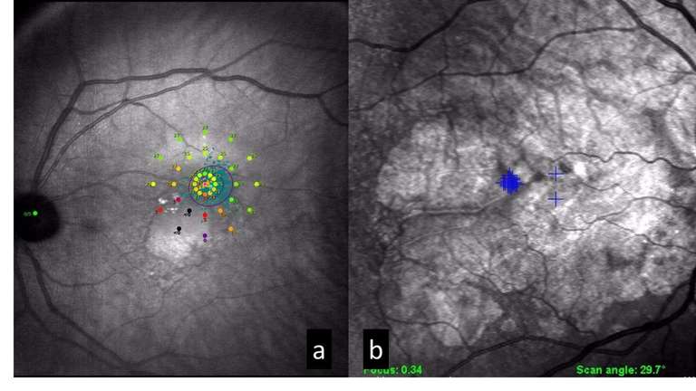 Figure 1. A. Patient 1, acuité visuelle 2/10. B. Patient 2, acuité visuelle 10/10. Pour exemple : les conséquences de l’altération rétienne du patient 2 ne peuvent être en rapport avec son AV. Si les plaintes des 2 patients diffèrent, le BOBV est justifié pour chacun.