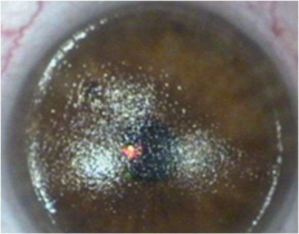 Figure 4. Photokératectomie réfractive.