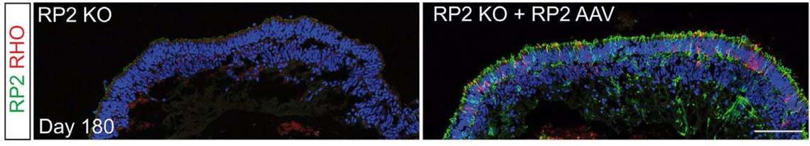 Épaisseur de la couche nucléaire externe chez les souris modèles pour la mutation RP2 et chez les souris modèles pour cette même mutation mais ayant reçu une version fonctionnelle du gène via un virus adéno-associé.