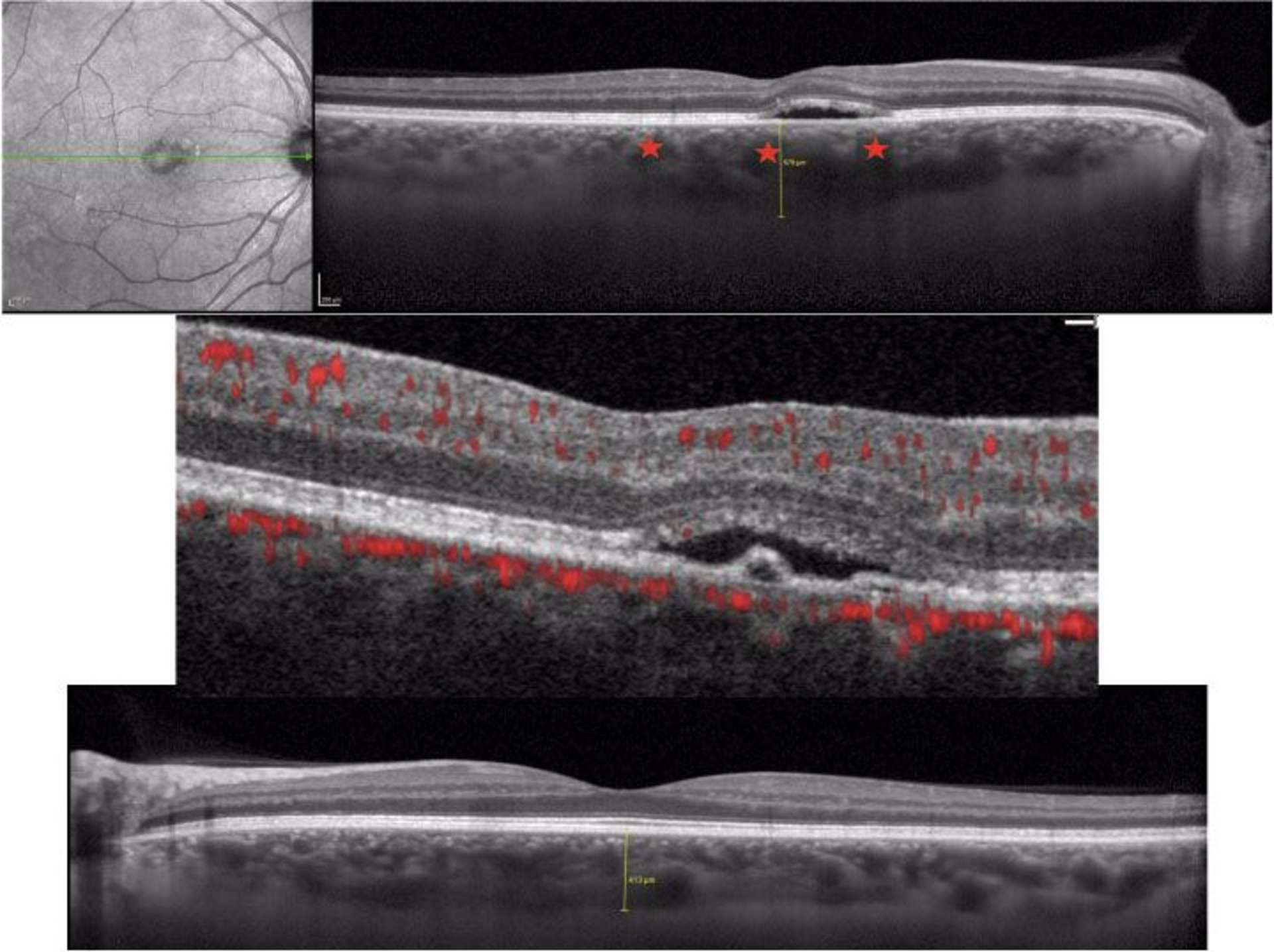 Figure 2. OCT et OCT-A. A. Image en infrarouge du pôle postérieur de l’œil droit. B. SD-OCT en mode EDI de l’œil droit retrouvant un décollement séreux rétinien rétrofovéolaire, associé à un allongement des articles externes des photorécepteurs, témoignant de la durée de la poussée de la CRSC (plusieurs semaines). L’épaisseur choroïdienne est augmentée (579 µm) avec la présence de pachyvaisseaux choroïdiens (étoiles). C. OCT-A de l’œil droit montrant une absence de flux sanguin au niveau du petit décollement de l’épithélium pigmentaire (absence de néovascularisation choroïdienne). D. SD-OCT en mode EDI de l’œil gauche retrouvant une pachychoroïde (413 µm).
