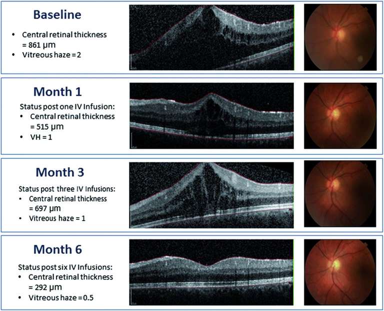 Changements observés quant à la transparence du vitré et à l’épaisseur maculaire centrale suite aux injections intravitréennes de 4 mg/kg de tocilizumab chez un patient de 18 ans atteint de panuvéite idiopathique avec œdème maculaire. Celui-ci n’a pas suivi d’autre traitement en parallèle.