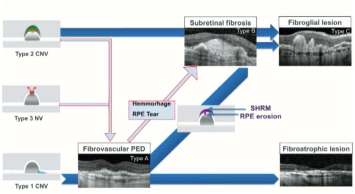 Figure 6. Évolution vers la fibrose d’un néovaisseau de type 1 surmonté de SHRM évoluant vers la fibrose : à Baseline, puis suivi à 1 an et à 2 ans, avec l’apparition d’une rupture de l’épithélium pigmentaire (tête de flèche vers le haut), puis fibrose à 4 et à 7 ans.
