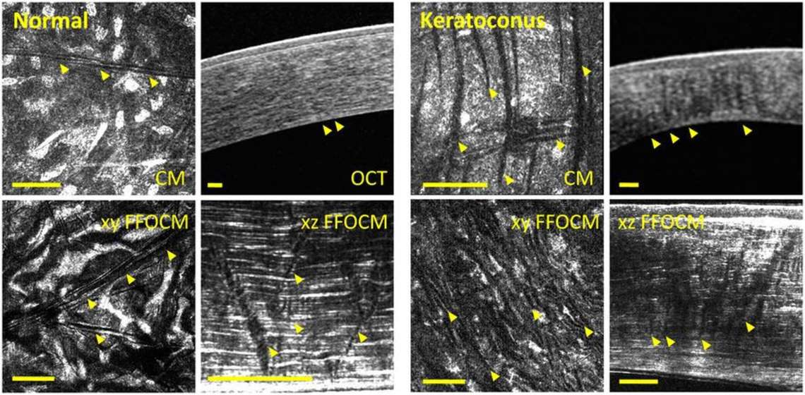 Observation des stries stromales dans des yeux sains (à gauche) ou atteints de kératocône (à droite), par (dans le sens des aiguille d’une montre) microscopie confocale, OCT, OCM plein champ avec vues en coupe transversale (xz) et en face (xy). La barre d’échelle correspond à 100 µm. Les flèches indiquent les stries, qui apparaissent peu nombreuses et obliques dans les yeux sains alors qu’elles sont nombreuses et verticales dans les yeux atteints de kératocône.
