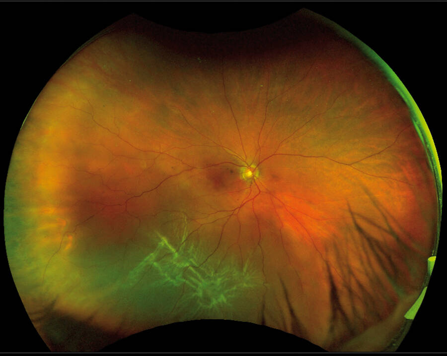 Figure 6. Décollement de rétine alimenté par 2 déchirures périphériques de petite taille, mais associé à un nœud de prolifération vitréo-rétinienne. Indication à une chirurgie endoculaire en première intention.
