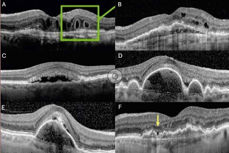 Figure 2 : Fluide non exsudatif en DMLA. A. Tubulations rétiniennes externes. B. Kystes dégénératifs.
C. Matériel vitteliforme. D. Effet Tente. E. DEP séreux avasculaire. F. Lésion hyporéflective rétinienne.
