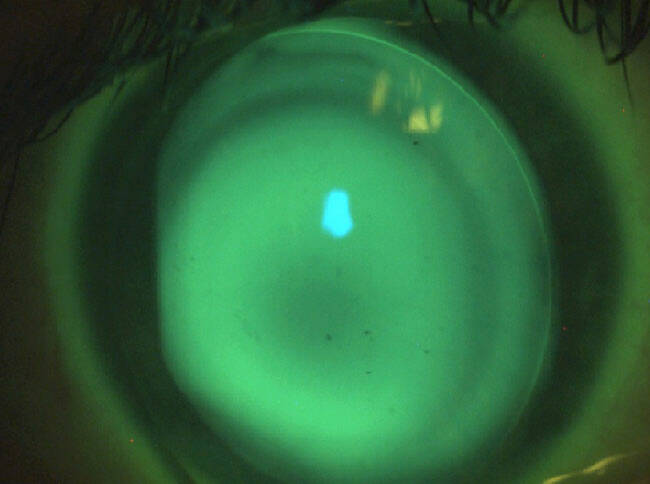 Figure 3. Examen biomicroscopique de l’œil droit après instillation de fluorescéine et utilisation d’un filtre jaune. L’aspect sombre au centre correspond à l’apex du cône, car le film lacrymal entre la lentille et la cornée y est plus fin. Le dégagement au bord correspond au cercle vert en périphérie de la lentille. 
