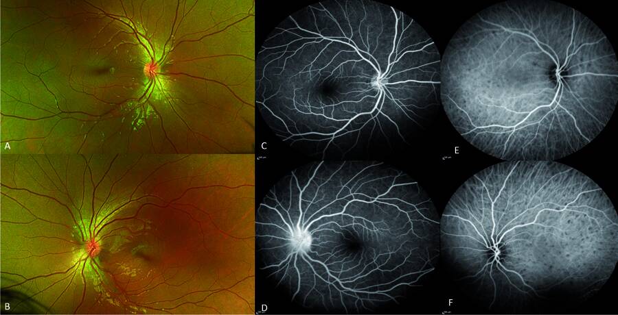 Figure 3. Patiente adressée pour une uvéite antérieure granulomateuse bilatérale. Le fond d’œil révèle une papillite gauche (B) qui est confirmée en angiographie à la fluorescéine (D) et l’ICG révèle la présence de nombreux granulomes choroïdiens bilatéraux (E et F). Une sarcoïdose oculaire et pulmonaire a été confirmée. 
