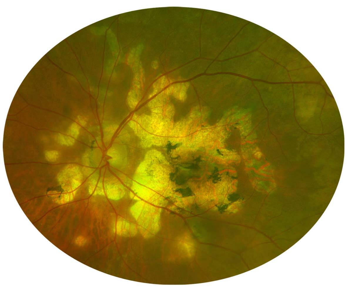 Figure 3. Choroïdite serpigineuse à point de départ papillaire et progressant au pôle postérieur.
