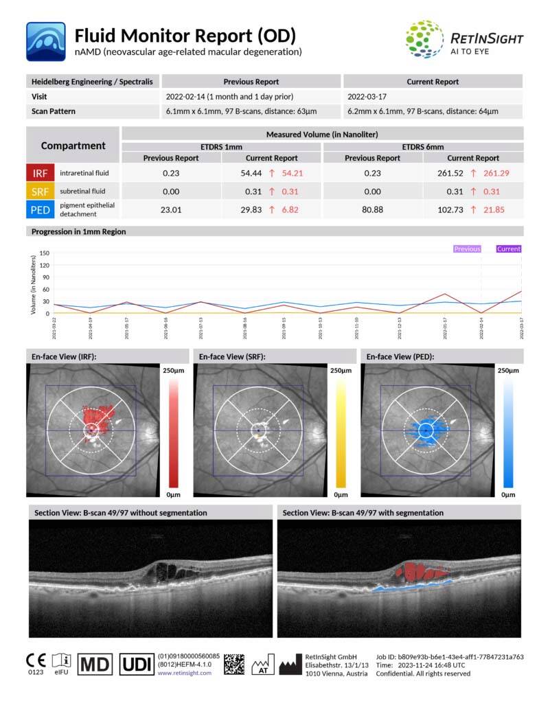 Figure 3. RetInSight Fluid monitor : exemple d’un rapport PDF généré par le module Fluid Monitor de RetInSight. Cette figure illustre un cas de récidive exsudative d’une DMLA néovasculaire, mettant en évidence une majoration des volumes – mesurés en nL – dans les compartiments intrarétiniens et sous-rétiniens et du décollement de l’épithélium pigmentaire[15].
