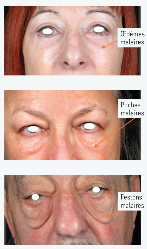 Figure 1. Classification des œdèmes malaires.
