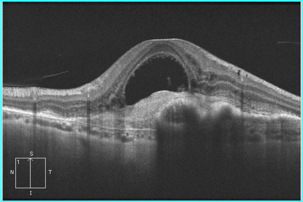 Figure 2. DSR en arche de pont avec aspect de décollement bacillaire dans une DMLA avec un néovaisseau de type 2.
