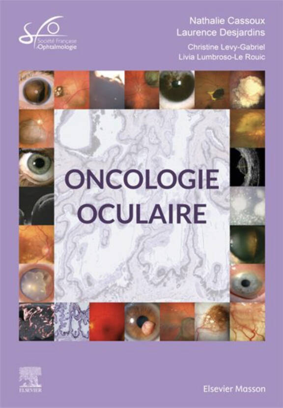 Oncologie oculaire Rapport SFO 2022, Nathalie Cassoux, Laurence Desjardins Elsevier-Masson, mai 2022, 456 pages, 285 e. ISBN : 229476594
