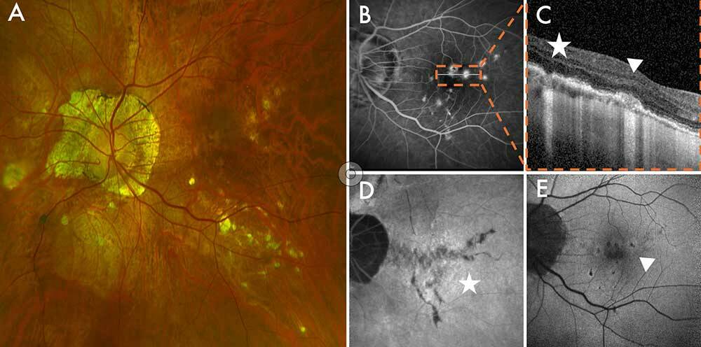 Figure 3. Imagerie multimodale d’une patiente de 34 ans atteinte de PIC. Le panneau (A) montre une photographie en couleur du fond d’œil d’un œil à aspect myopique, présentant des zones d’atrophie en plaques et de multiples lésions de PIC. (B) L’angiographie à la fluorescéine révèle plusieurs foyers hyperfluorescents au pôle postérieur. Le panneau (C) montre une coupe OCT à travers ces zones : en position sous-fovéolaire (pointe de flèche), on observe une lésion active caractérisée par un dédoublement du complexe membrane de Bruch–EPR, une rupture de la membrane de Bruch, une hypertransmission choroïdienne et un épaississement choroïdien ; à l’inverse, une lésion inactive adjacente (étoile) se caractérise uniquement par une interruption du complexe membrane de Bruch–EPR avec hypertransmission choroïdienne. Le panneau (D) montre une angiographie au vert d’indocyanine en phase tardive, avec une ligne hypofluorescente ramifiée compatible avec des lacquer cracks (étoile). Le panneau (E) montre l’autofluorescence du fond d’œil au niveau du pôle postérieur, où les lésions actives apparaissent comme des zones de légère hyperautofluorescence (pointe de flèche), tandis que la cicatrice atrophique centrale apparaît hypoautofluorescente.
