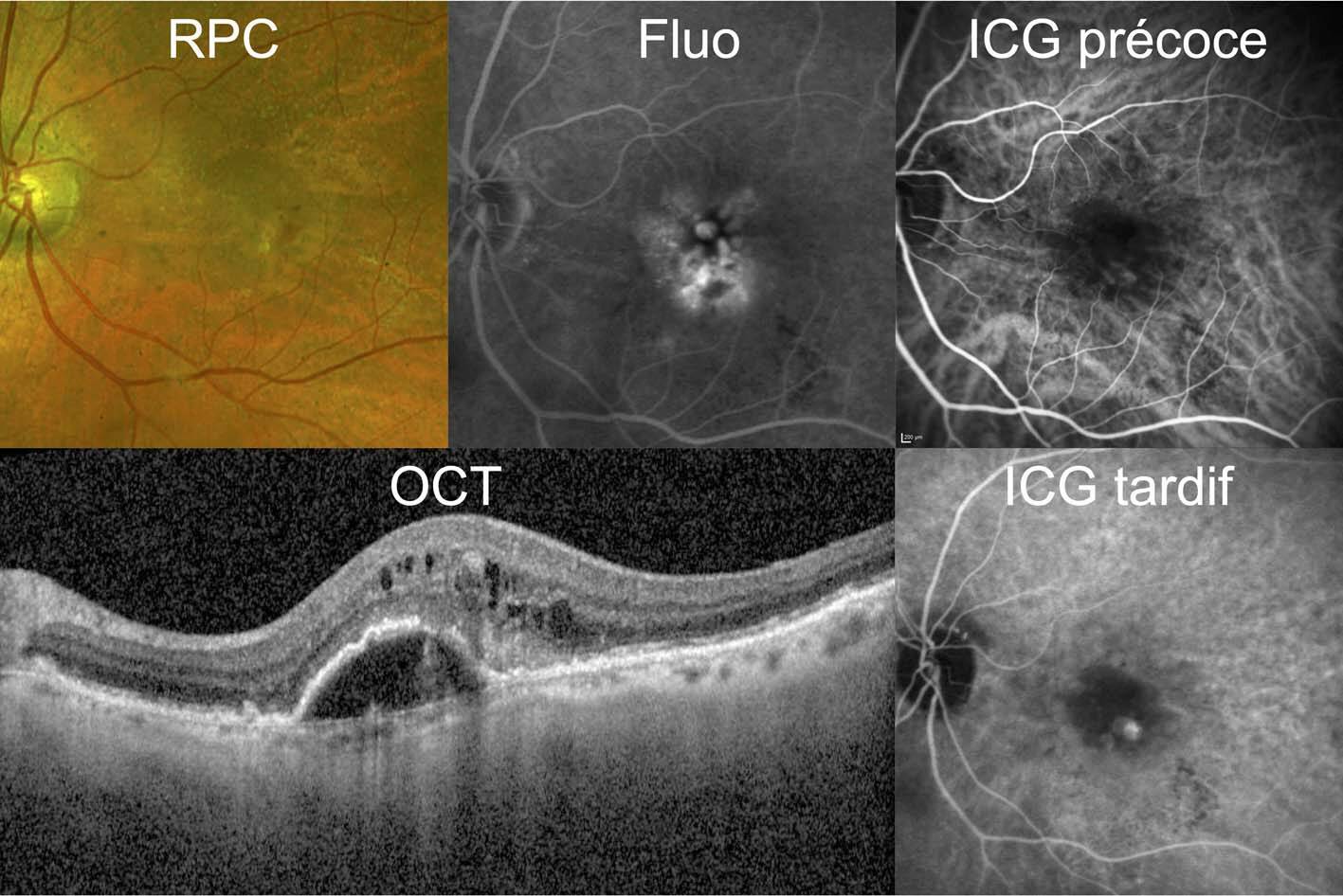 Figure 4. Imagerie multimodale d’un néovaisseau de type 3. La rétinographie montre une hémorragie rétinienne en regard de la terminaison d’un vaisseau rétinien maculaire. Des pseudo-drusen réticulés sont aussi visibles. L’angiographie à la fluorescéine retrouve un remplissage des logettes cystoïdes rétiniennes. L’ICG met en évidence la prise de contraste d’un hot spot qui signe la présence d’un néovaisseau rétinien. L’OCT montre une image d’hyperréflectivité intrarétinienne avec des altérations de l’EP en regard, ainsi que du fluide intrarétinien.
