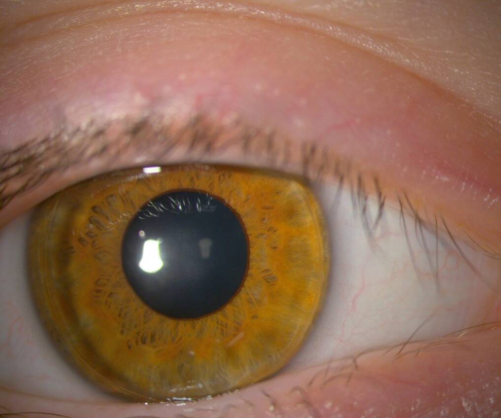 Figure 1. Photographie d’une lentille d’orthokératologie (source : Céline Ton Van).

