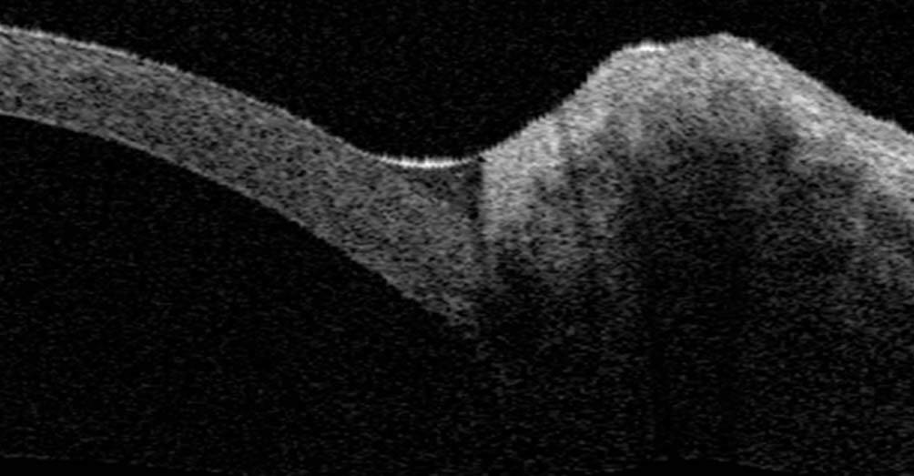 Figure 3. Image en OCT permettant d’évaluer le ménisque de larmes.
