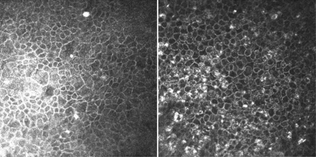 Figure 1. Cellules épithéliales superficielles hyperréflectives (à gauche), cellules épithéliales basales activées (à droite).
