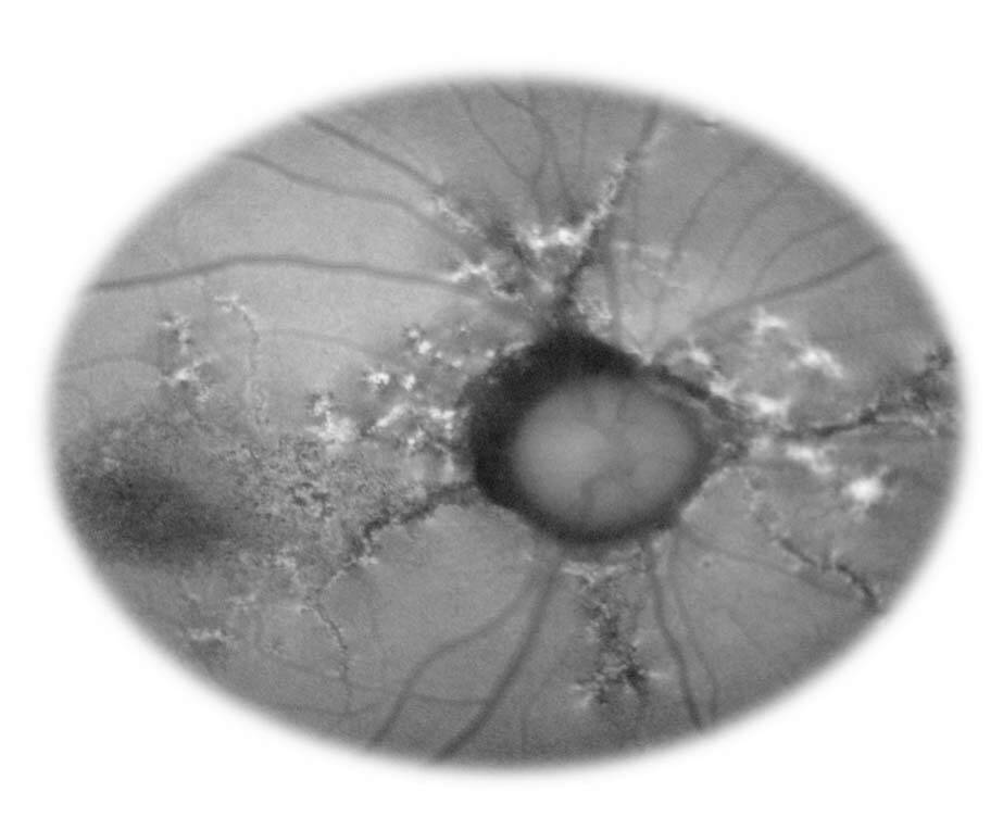 Figure 2. Stries angioïdes hypo-autofluorescentes et dépôts réticulés hyper-autofluorescents dans un PXE.
