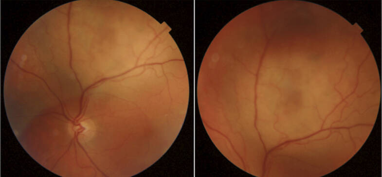 Figure 1. Rétinophotographie de l’œil gauche, volumineuse lésion supéromaculaire (Topcon Dri OCT Triton plus – CHBA Vannes, service d’ophtalmologie).

