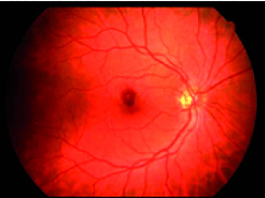 Figure 2. Rétinographie de l’œil droit dans le cadre d’une leucémie aiguë lymphoblastique retrouvant des hémorragies interpapillo-maculaires.&nbsp;
