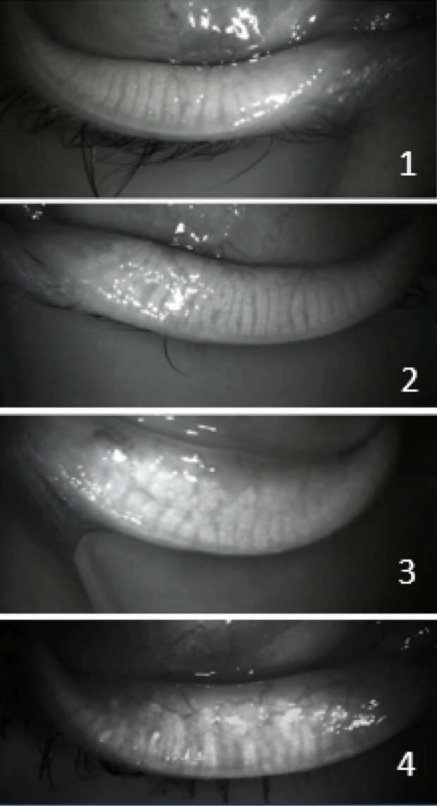 Figure 4. Classification des télangiectasies en meibographie (clichés Dr A.-S. Marty).
