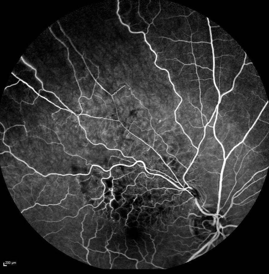 Figure 5. Angiographie mettant en évidence le territoire d’hypoperfusion veineuse.
