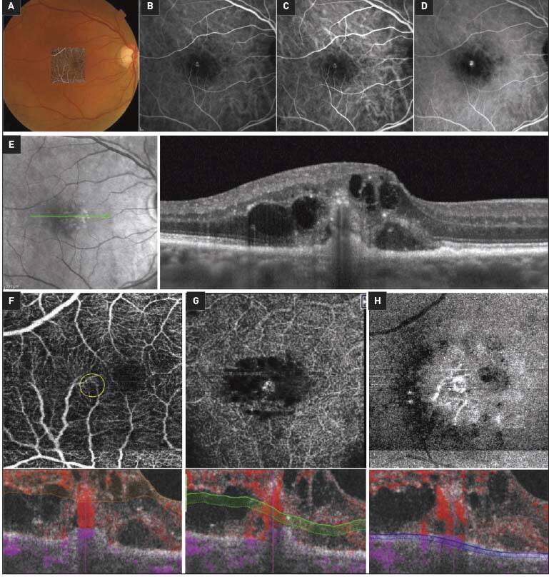 Figure 5. DEP associé à une néovascularisation de type 3. A. Cliché couleur avec superposition de l’OCT-A. B, C et D. L’ICG montre un DEP rétrofovéal avec 2 hot spots. E. L’OCT montre un DEP avec exsudation. F, G et H. L’OCT-A à différentes segmentations montre un hypersignal de flux, intrarétinien dense, en touffe.

