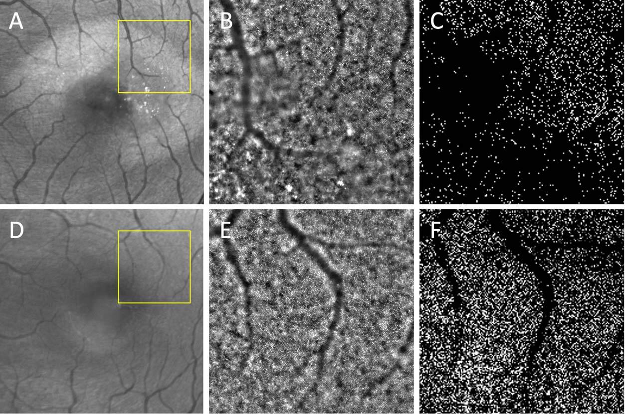 Figure 3. Clichés en blue reflectance et optique adaptative d’un œil gauche d’un MacTel et d’un œil sain. A. La MacTel zone est bien visible sur le cliché en blue reflectance. B et C. L’optique adaptative de la zone encadrée en jaune met en évidence une raréfaction de la mosaïque des cônes dans la MacTel zone. D. Cliché en blue reflectance de l’œil sain. E et F. La mosaïque des cônes est dense en optique adaptative.
