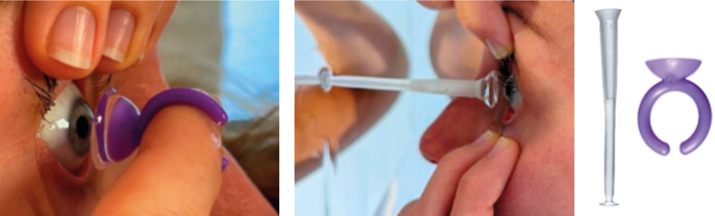 Figure 2. Ventouse SL Plunger et Ring (source : LCS). 
