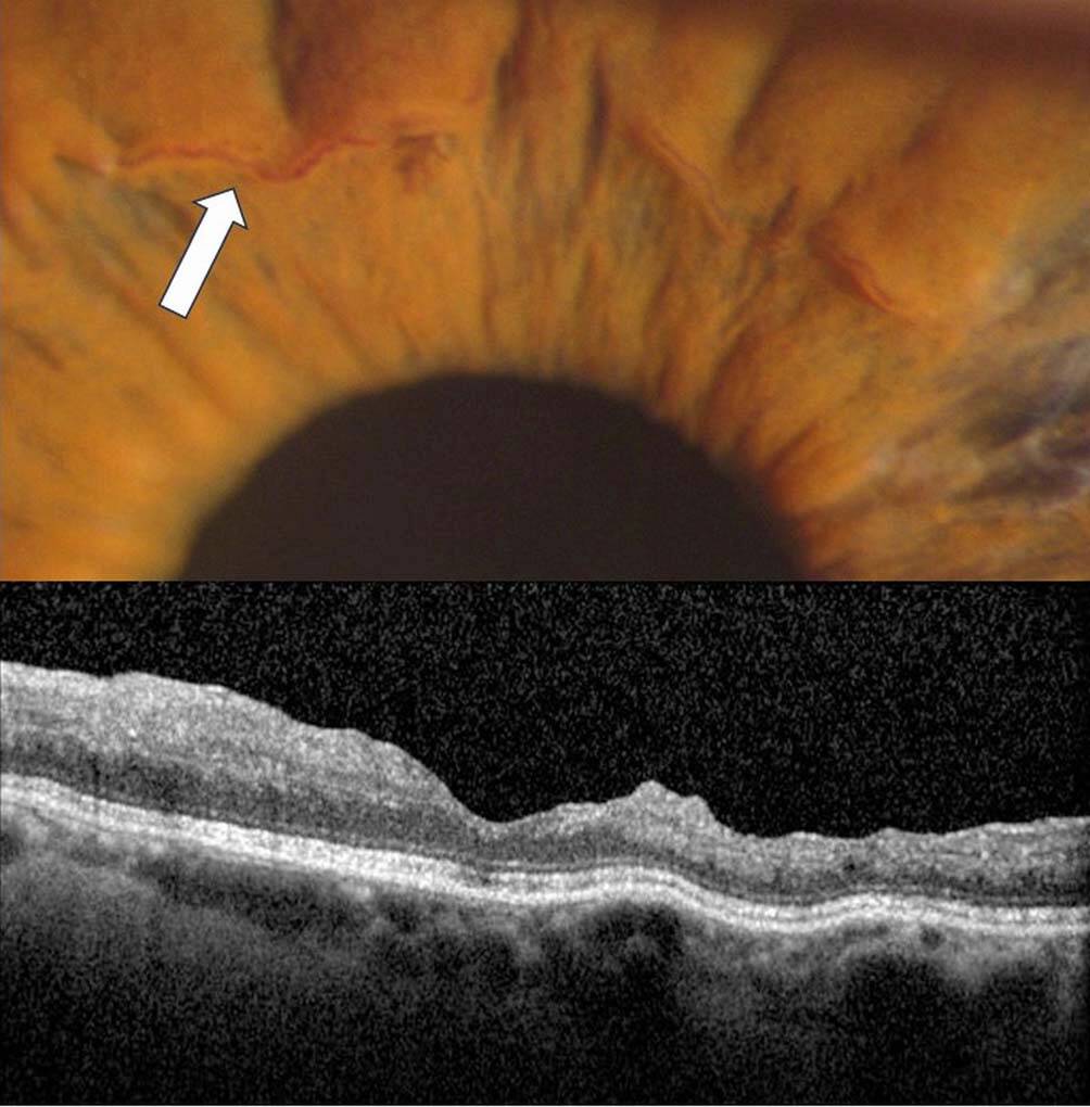 Figure 3. Atrophie des couches rétiniennes internes en OCT B-scan, associée à une reperméabilisation du cercle artériel mineur (absent sur l’iris controlatéral) dans un contexte d’OVCR. Indication d’AFR.
