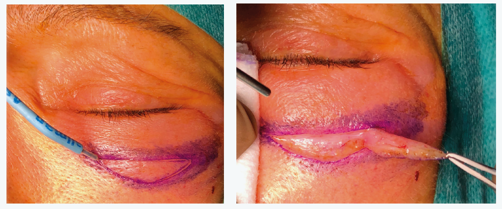 Figure 7a et 7b. Résection malaire directe.
