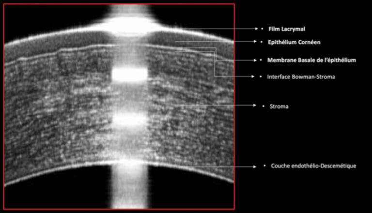 Figure 1. Imagerie OCT B-scan de haute résolution en Spectral Domain, résolution axiale optique de 5 µ d’une cornée normale mettant en évidence une parfaite individualisation de l’épithélium cornéen.
