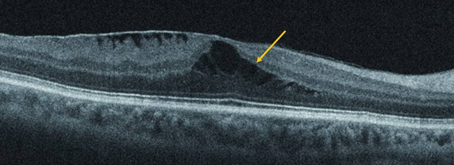 Figure 3. Cliché OCT d’une membrane épirétinienne idiopathique avec fovéoschisis. Clivage intrarétinien au niveau de la couche des fibres de Henlé (flèche).
