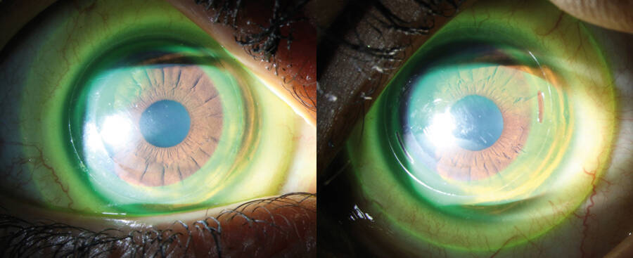 Figure 3. Notre patiente équipée de lentilles hybrides Eyebrid Silicone, associant lentille rigide au centre et jupe souple en périphérie.
