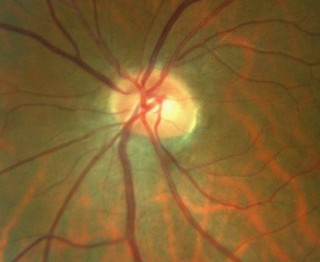 Figure 2. Œil myope de – 8 D avec dysversion papillaire sans glaucome.
