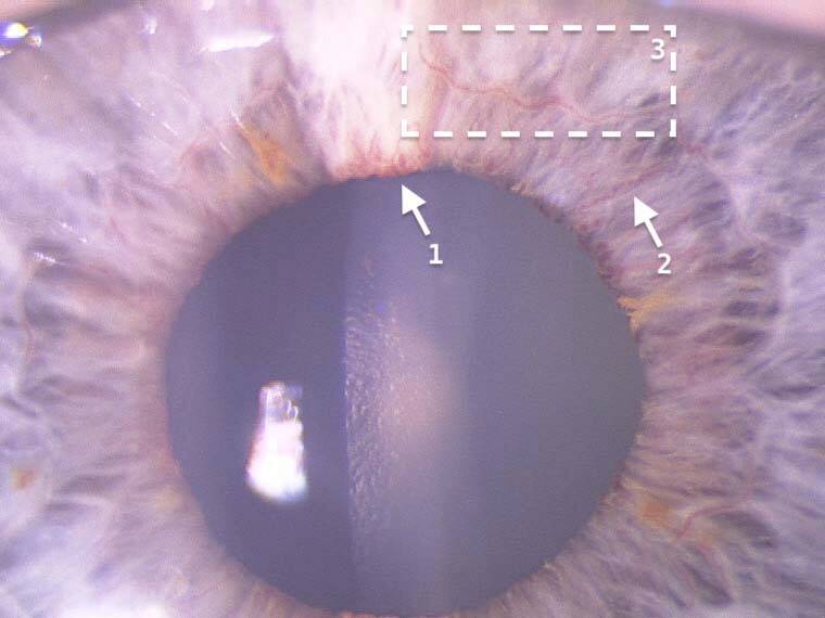 Figure. Association des différents signes précurseurs de rubéose irienne chez un même patient. 1. Dilatations micro-anévrysmales. 2. Dilatations radiaires. 3. Reperfusion de la collerette irienne.
