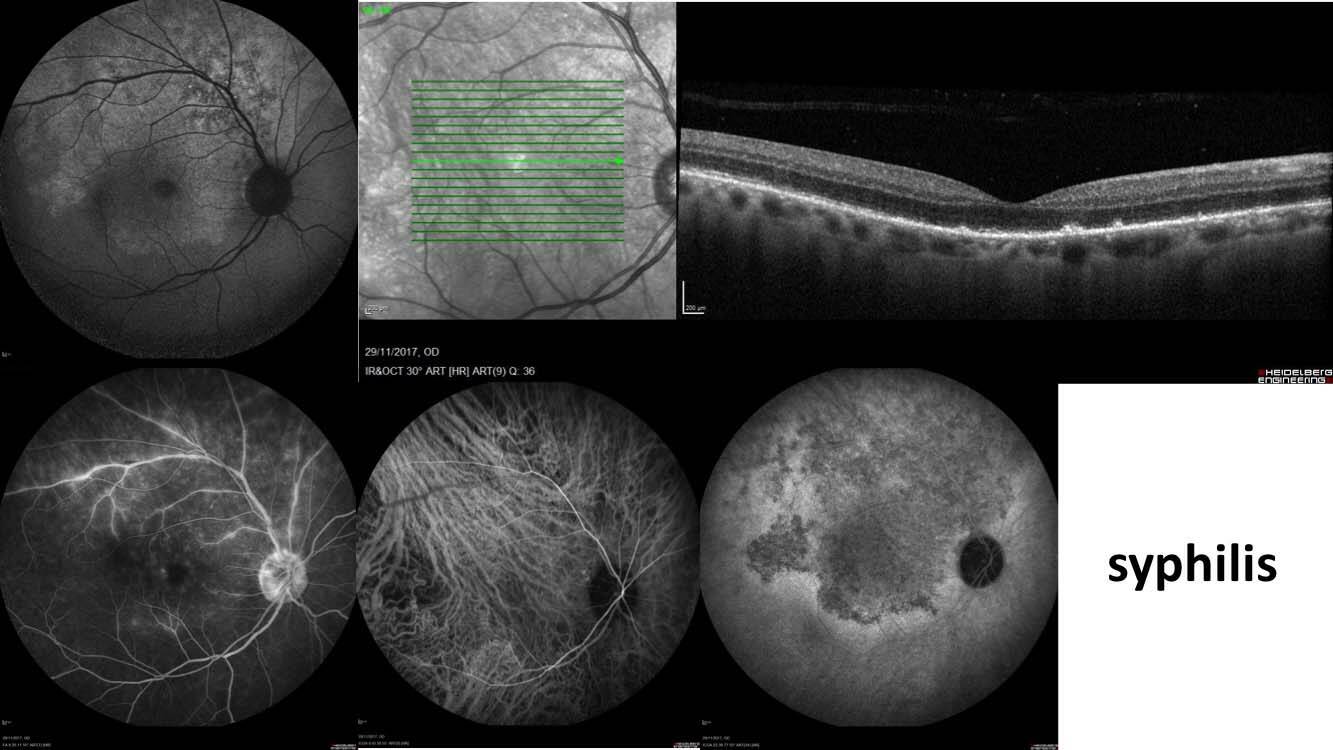 Figure 5. Imagerie multimodale dans une syphilis avec en autofluorescence une plaque plutôt hyper-autofluorescente ; en OCT, des cellules dans le vitré et des points hyperréflectifs sous-rétiniens ; une vascularite veineuse des gros troncs temporaux supérieurs et papillite en FLUO ; et une plaque hypofluorescente en ICG persistant aux temps tardifs relativement pathognomonique d’une atteinte syphilitique.
