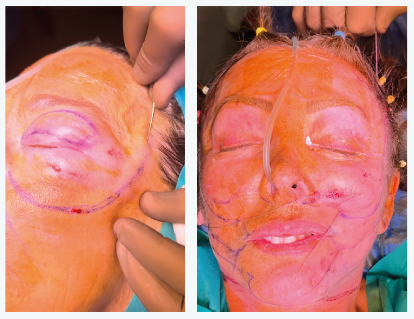 Figures 12 et 13. Lifting fermé par pose de fils permanents.
