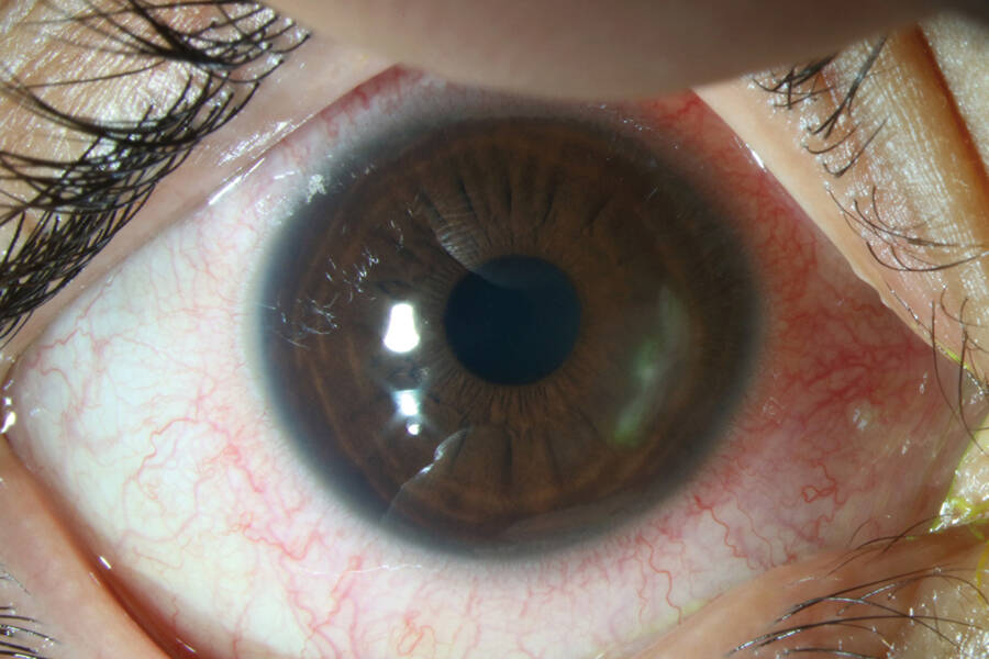 Figure 4. Abcès périphérique, apparu après que notre patiente a porté les lentilles souples de sa sœur pendant 2 semaines.
