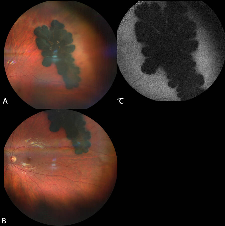 Figure 3. A gauche : Photos couleur. A droite : Cliché en autofluorescence.
