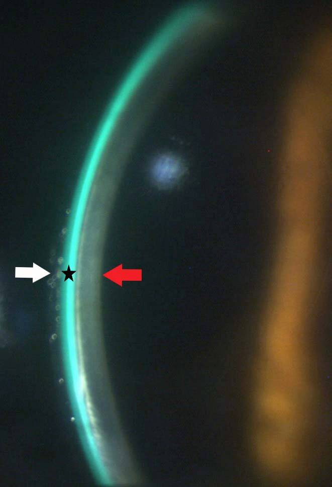 Figure 7. Examen en lumière blanche en fente fine et en fort grossissement. Cette coupe optique permet de visualiser la lentille, l’espace liquidien coloré par la fluorescéine ainsi que la cornée.
